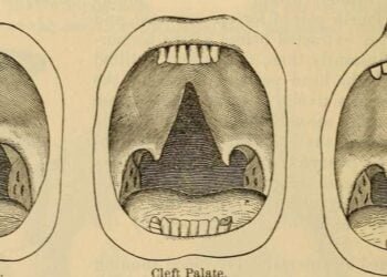300-year-old prosthesis of gold, silver, and wool helps 18th-century man live with cleft palate in Poland