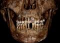 17th-century Frenchwoman's gold dental work was likely torturous to her teeth