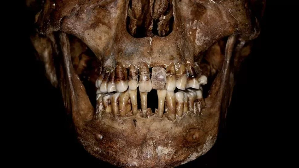 Hot news: discovery of gold teeth of a 17th century French woman capable of tearing her teeth.nguyen01