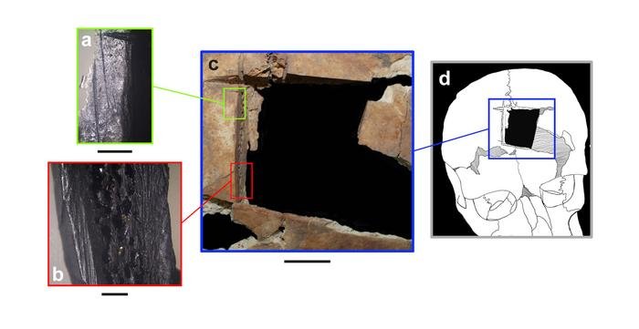 Archaeologists uncovered early evidence of cranial surgery in ancient Near East