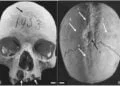 Archaeologists found evidence of surgery on medieval woman’s skull