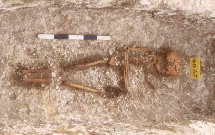 Ancient DNA reveals West African ancestry in 7th-century skeletons from England. Skeleton of the girl with West African ancestry buried at Updown, Kent. Credit: Duncan Sayer et al, Antiquity (2025). CC BY 4.0