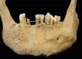 Earliest known dental bridge in Scotland found in medieval Aberdeen burial