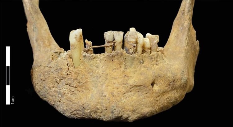 Earliest known dental bridge in Scotland found in medieval Aberdeen burial
