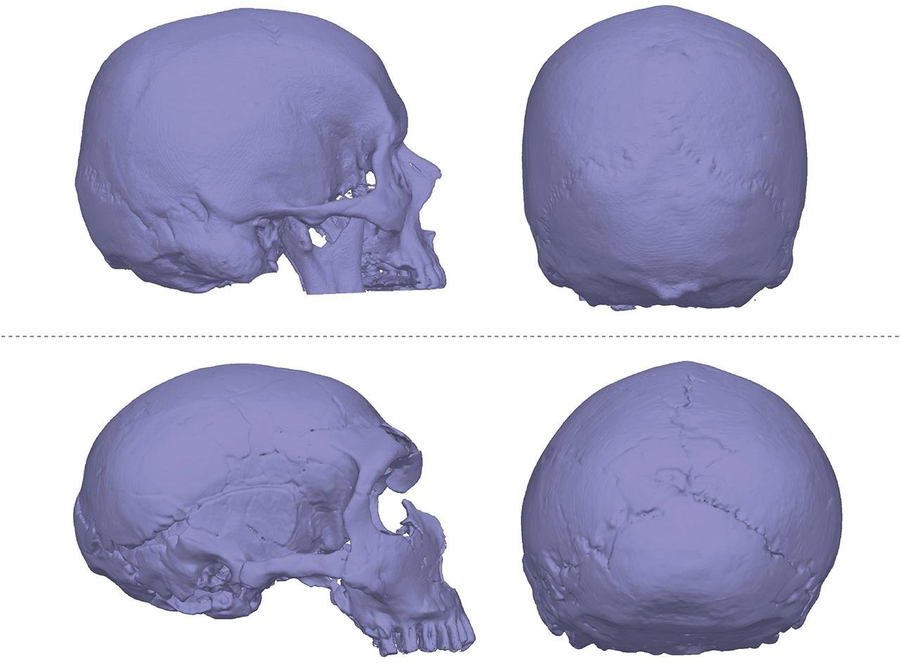 Neanderthal genes linked to rare brain-skull disorder, study finds