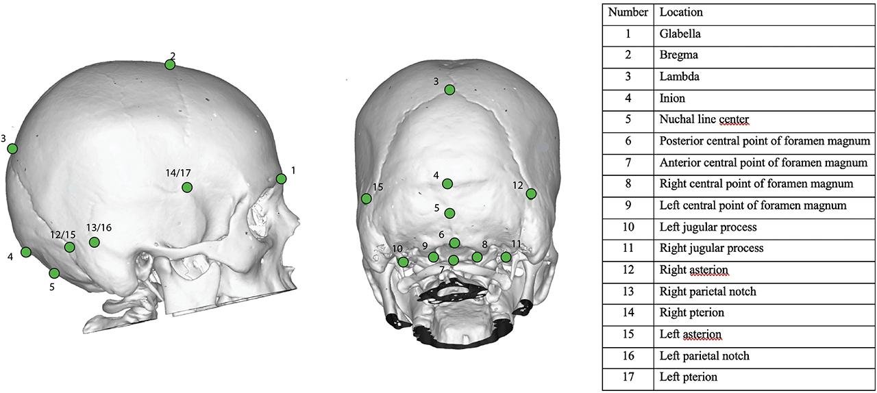 Neanderthal genes linked to rare brain-skull disorder, study finds