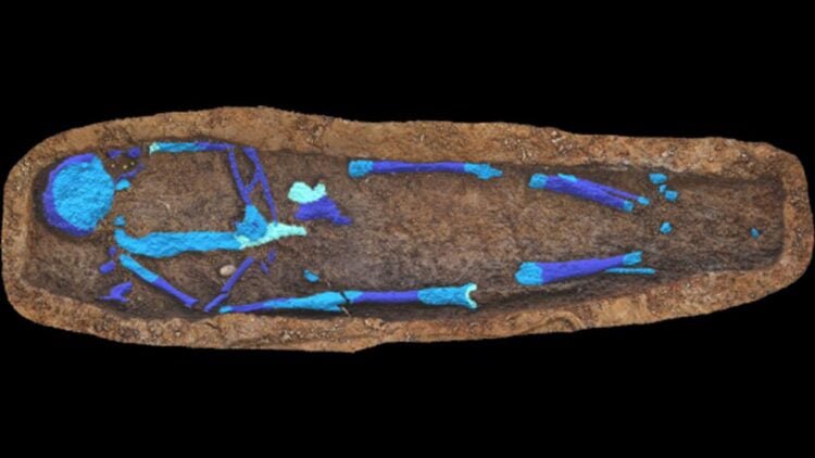 Rare 'porcelain gallbladder' found in early 20th-century asylum cemetery
