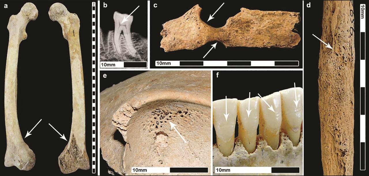 Roman urbanism was harmful to public health, new study confirms