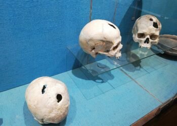 Traces of an ancient skull trepanation discovered in Çatalhöyük