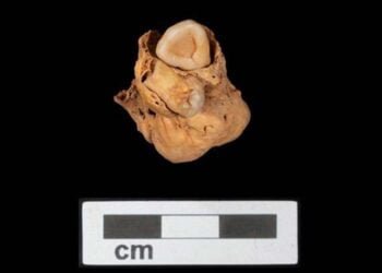 Oldest known case of teratoma discovered in Egyptian burial