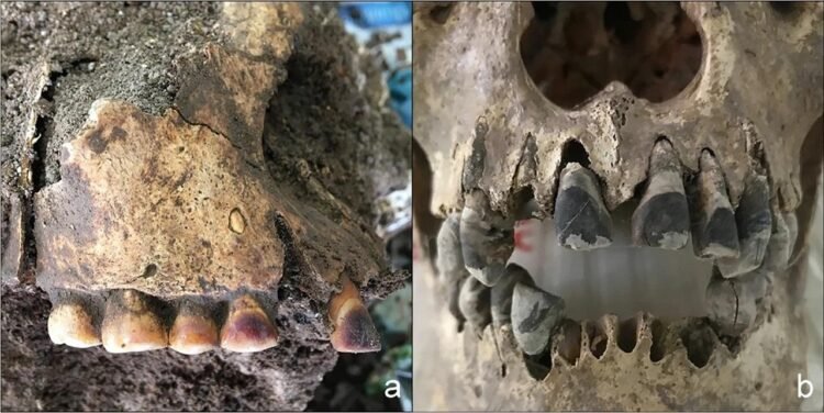 2,000-year-old Vietnamese tooth blackening practice found in Iron Age burial