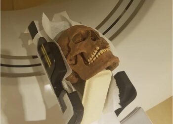 CT scans of Viking-age skulls reveal widespread disease